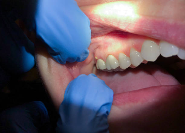 Best Emergency Dentist for Lost Fillings or Crowns in Macclenny, FL
